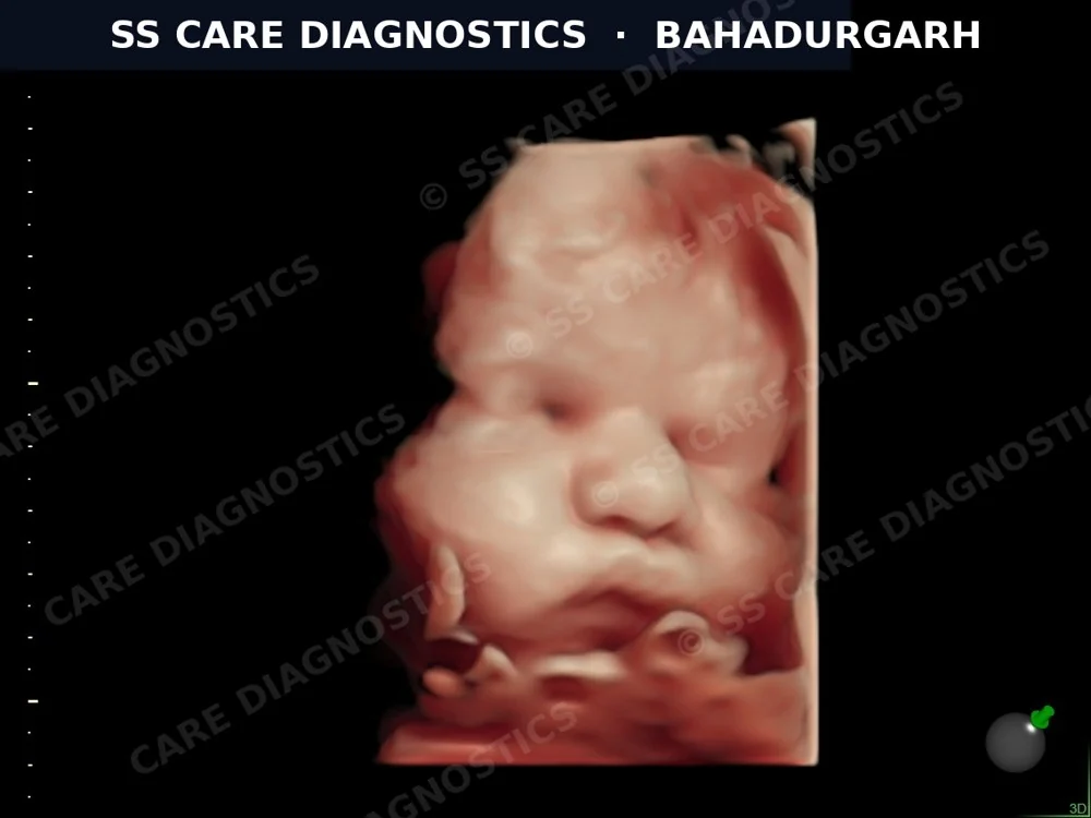 4D Fetal Imaging