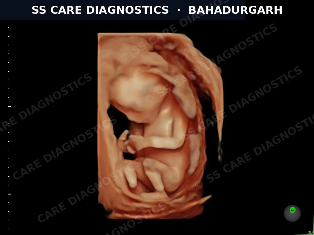 Advanced 3D Obstetric Scan