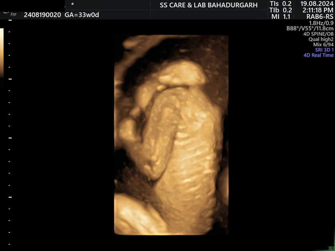 Anencephaly–Exencephaly Spectrum