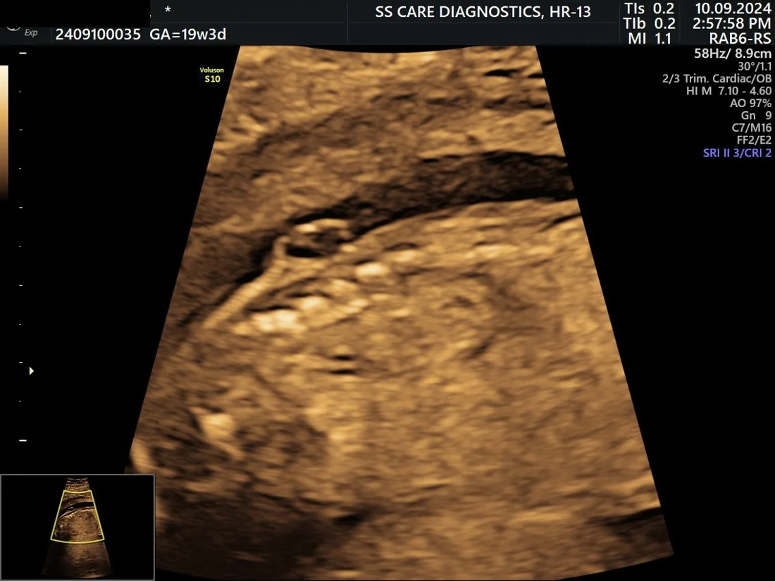 Neural Tube Defect (NTD)