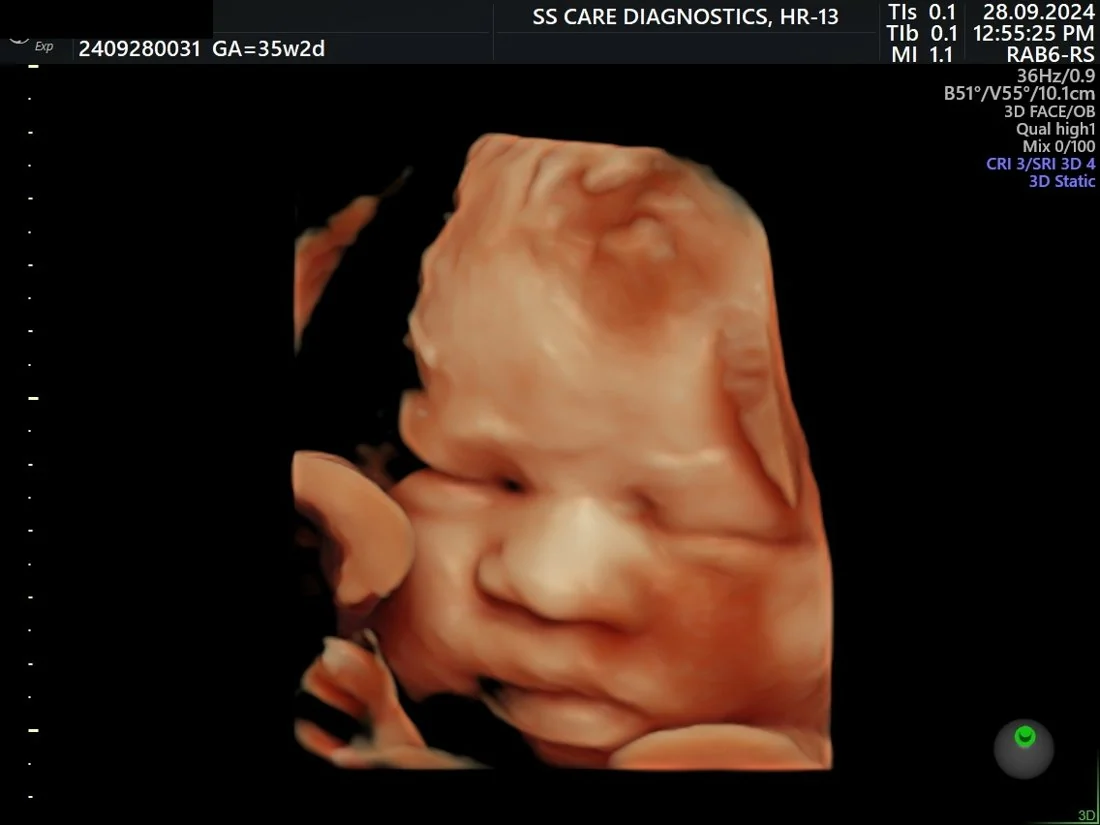 High-Definition 3D Fetal Face