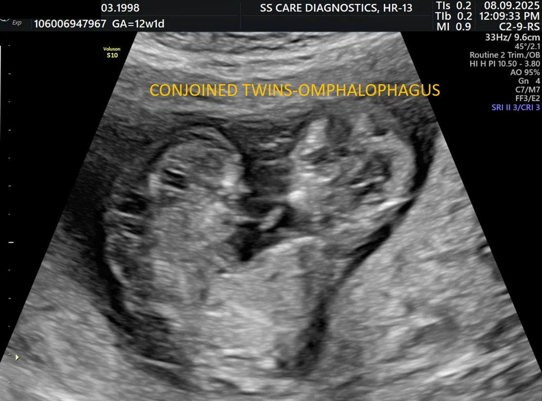 Conjoined Twins — Antenatal Detection