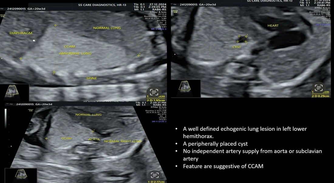 CCAM — Congenital Lung Malformation