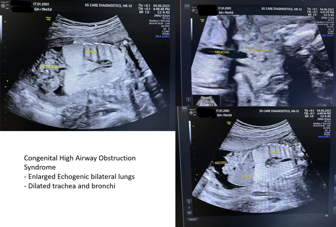 CHAOS — Congenital High Airway Obstruction