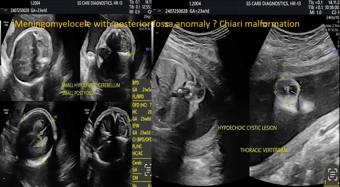 Chiari Malformation