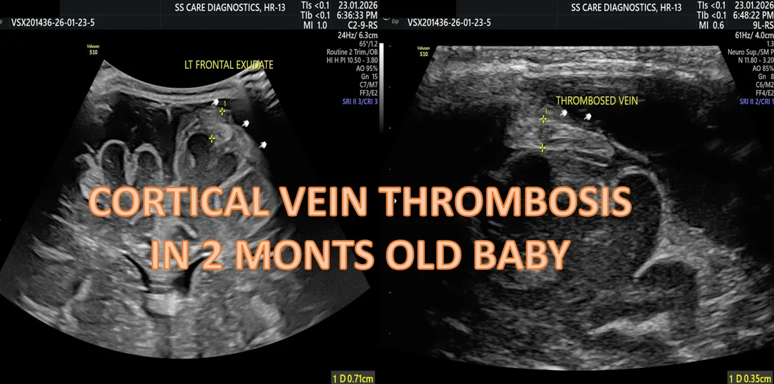 Cortical Vein Thrombosis (Neonatal)