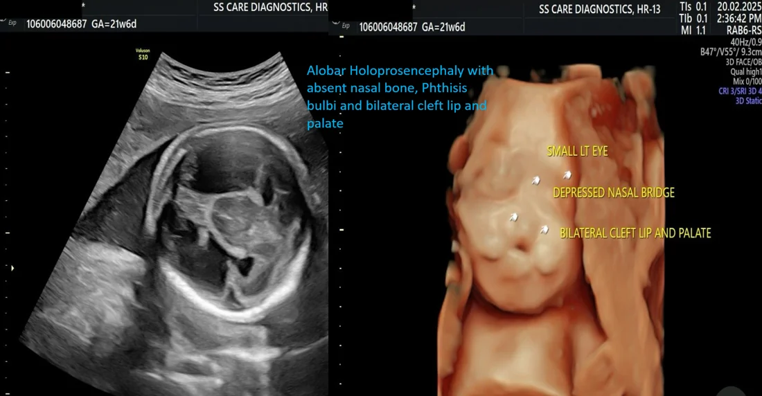 Holoprosencephaly