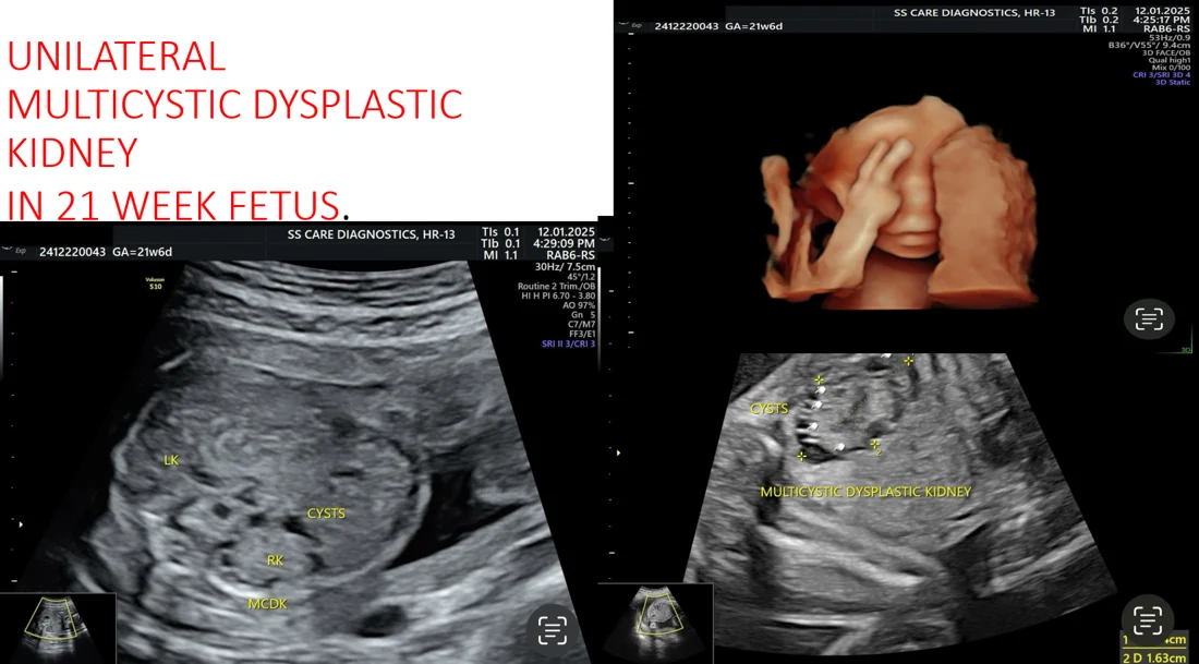 Multicystic Dysplastic Kidney (MCDK)