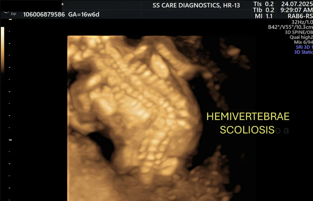 Hemivertebrae / Scoliosis