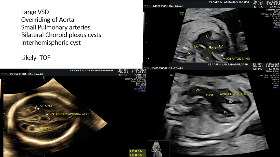Tetralogy of Fallot (TOF) — Fetal Heart