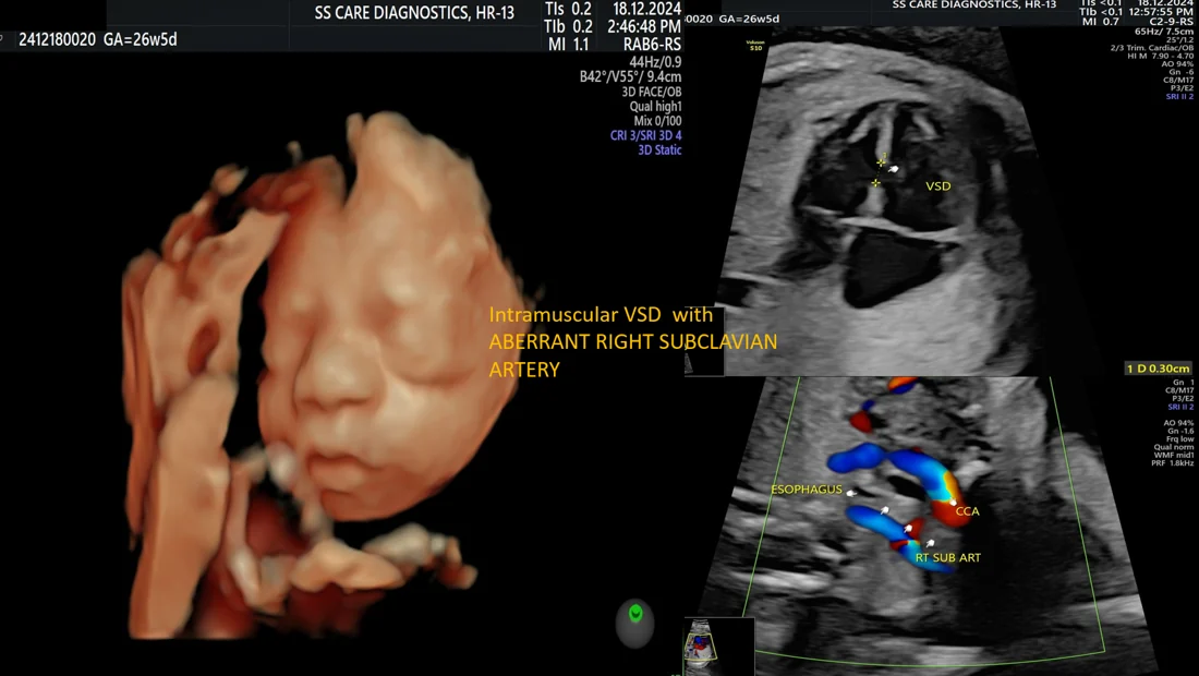 VSD with ARSA — Fetal Echo