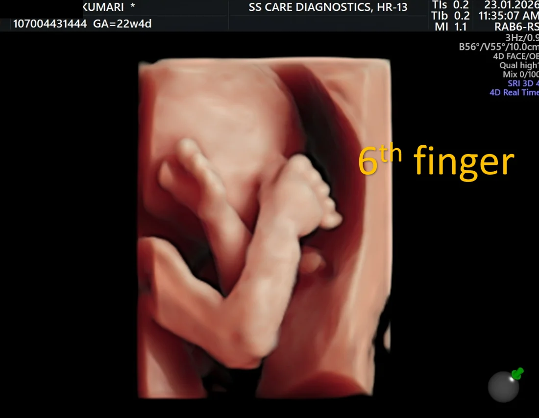 Polydactyly (Extra Finger)